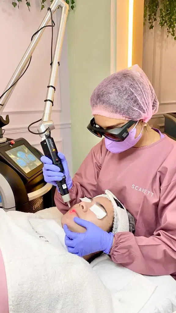 Lips Rejuvenation Picosure Laser treatment