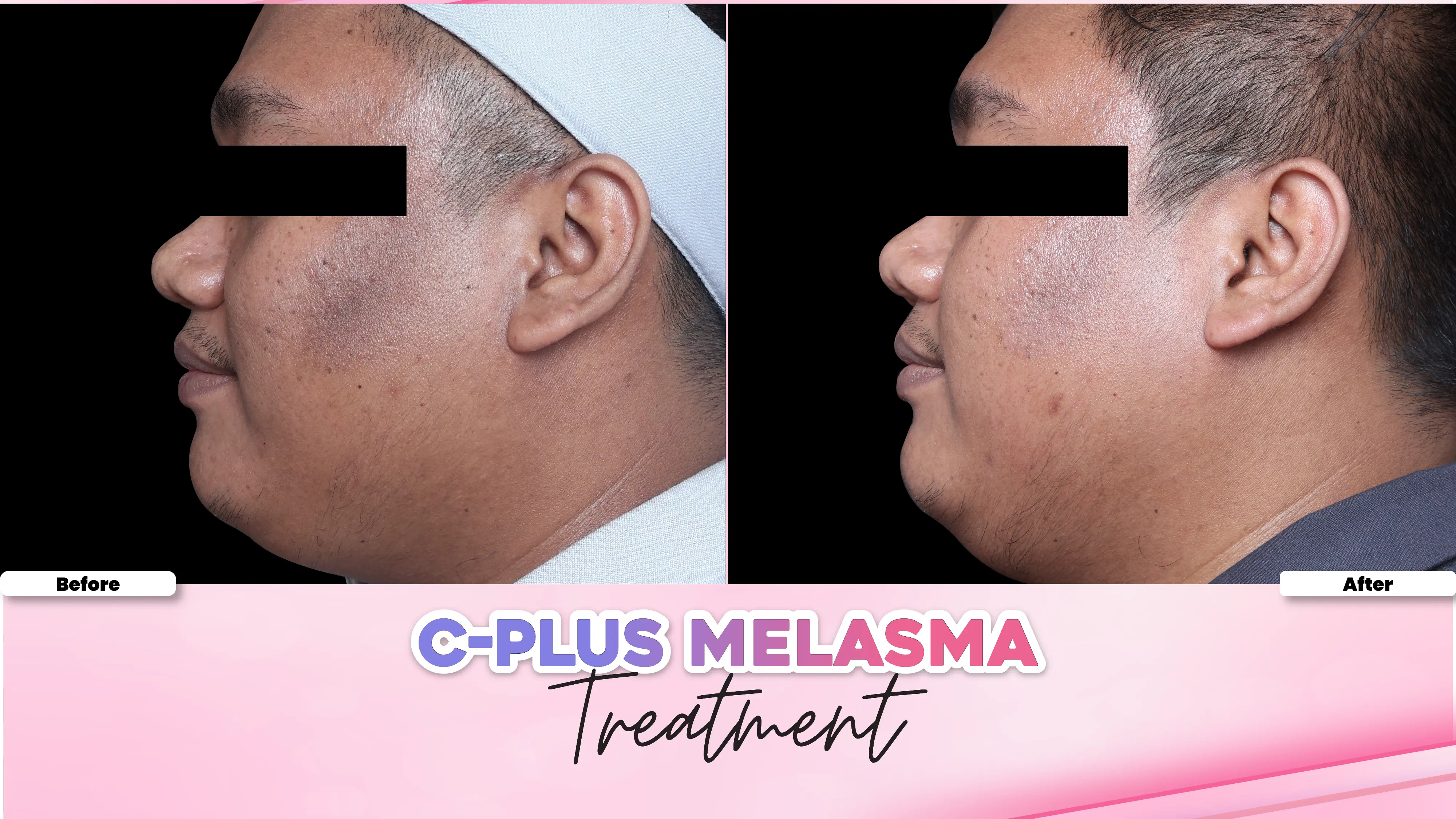 Before after treatment