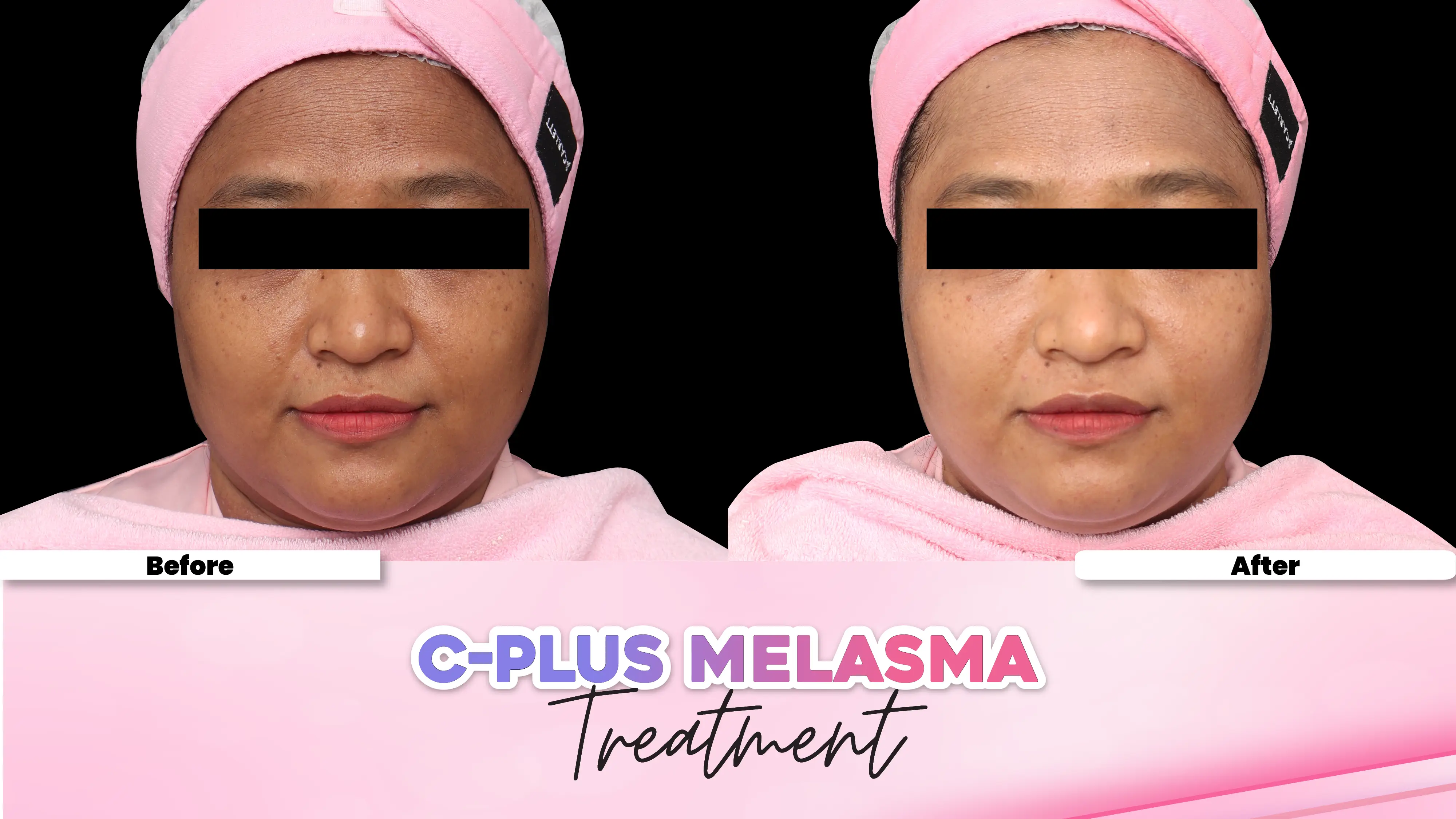 Before after treatment