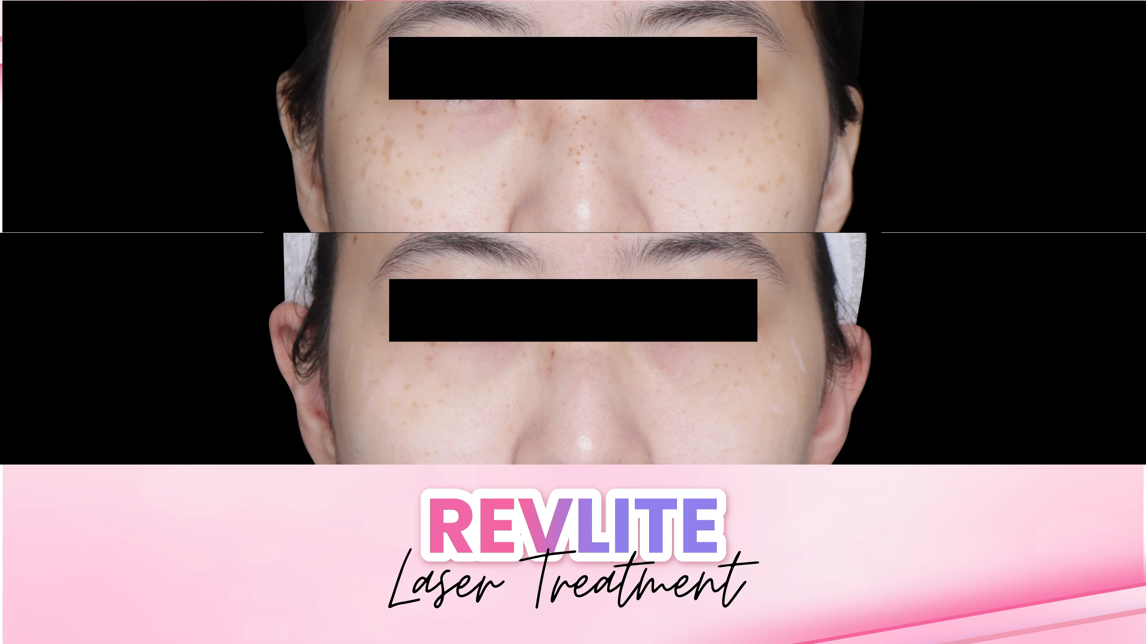Before after treatment