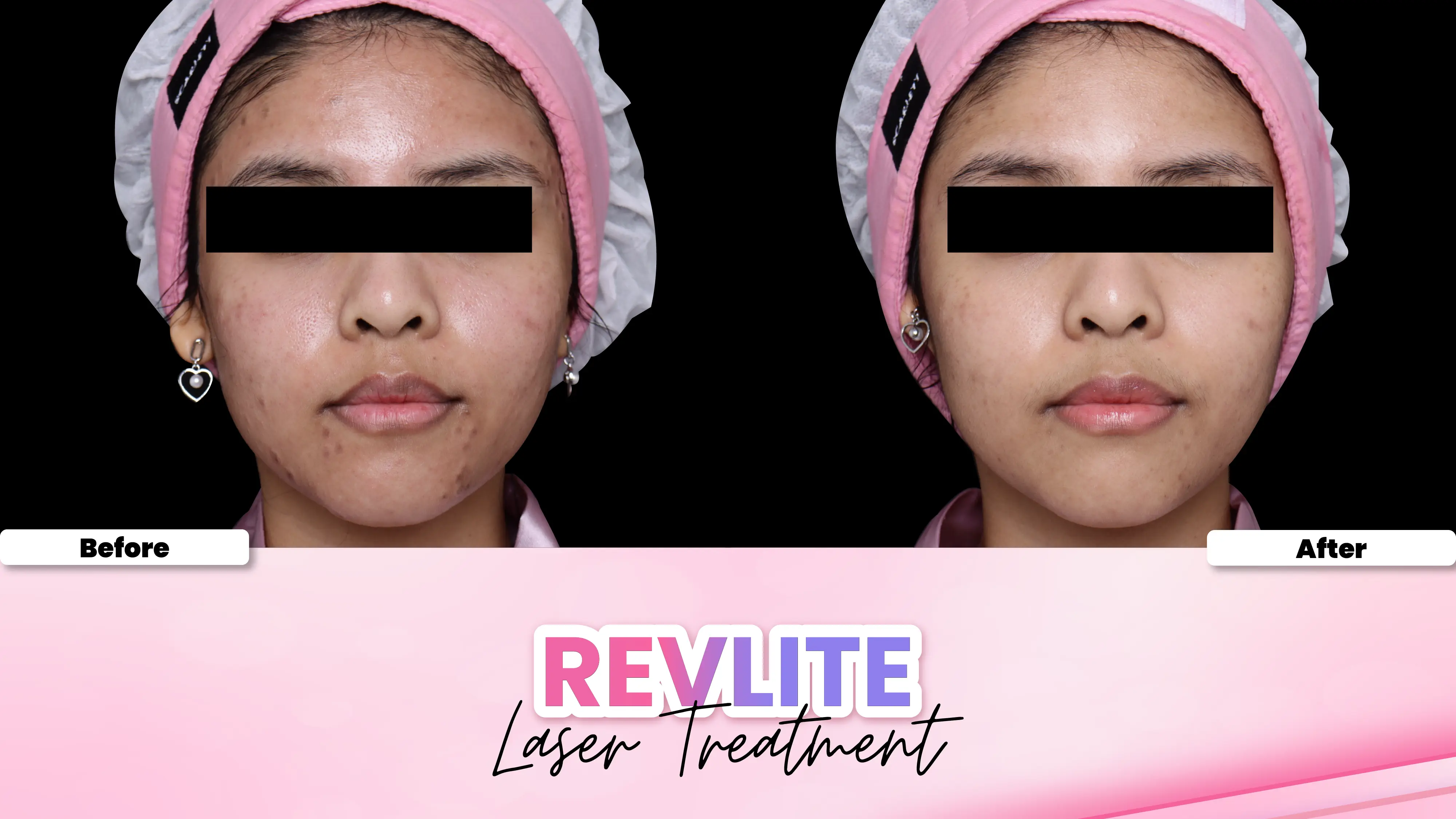 Before after treatment