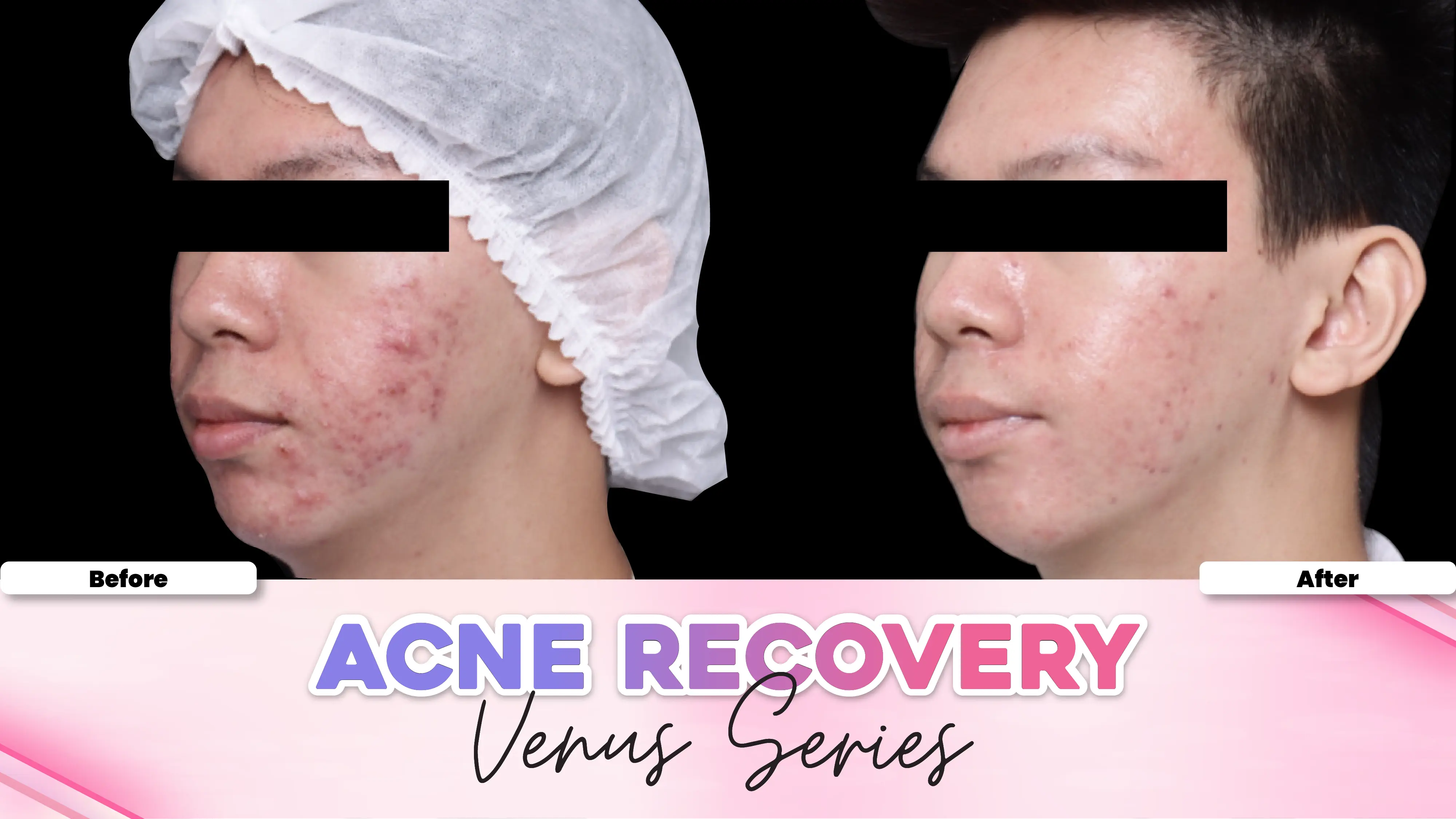 Before after treatment