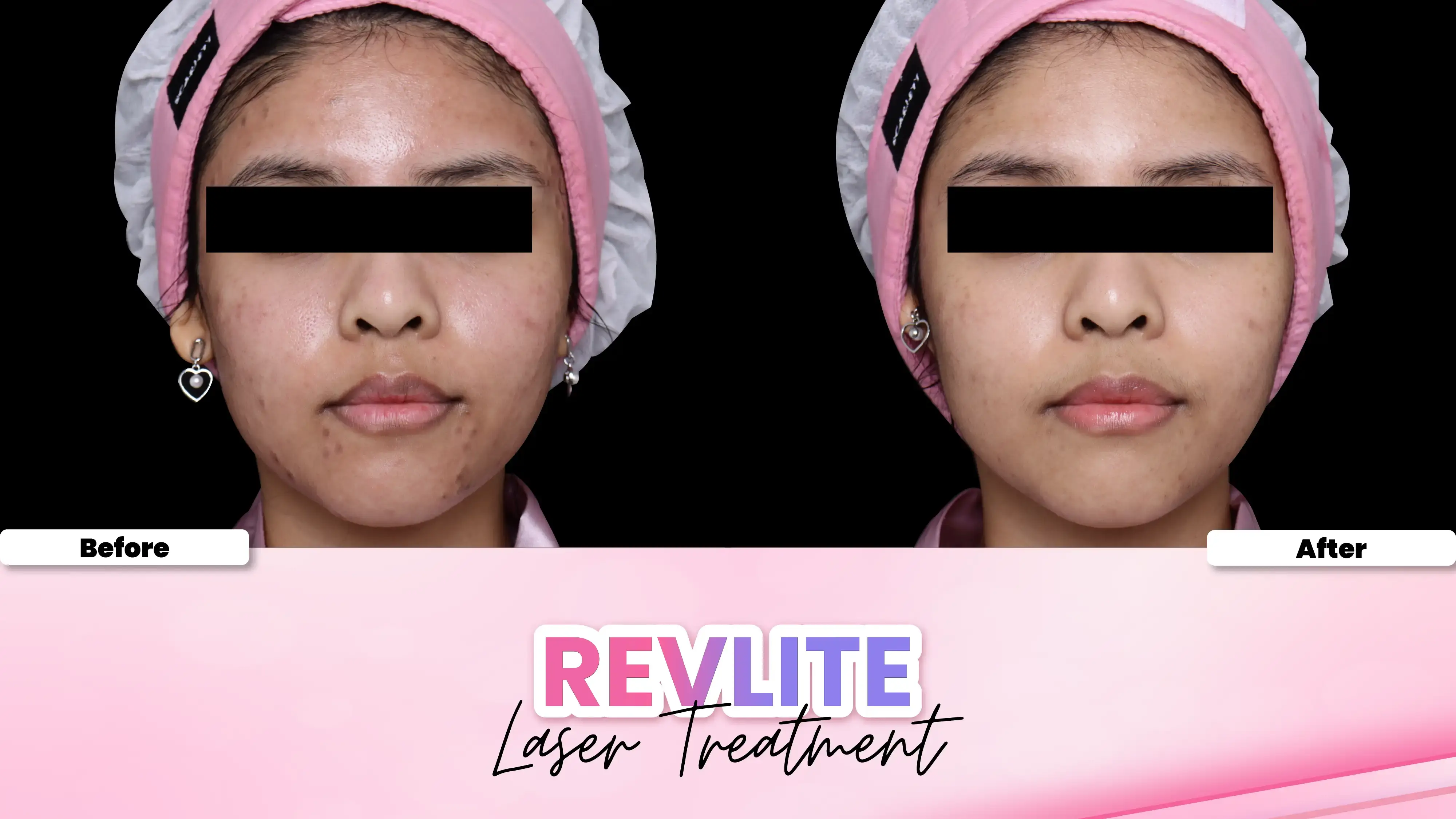 Face Rejuvenation Revlite Laser treatment