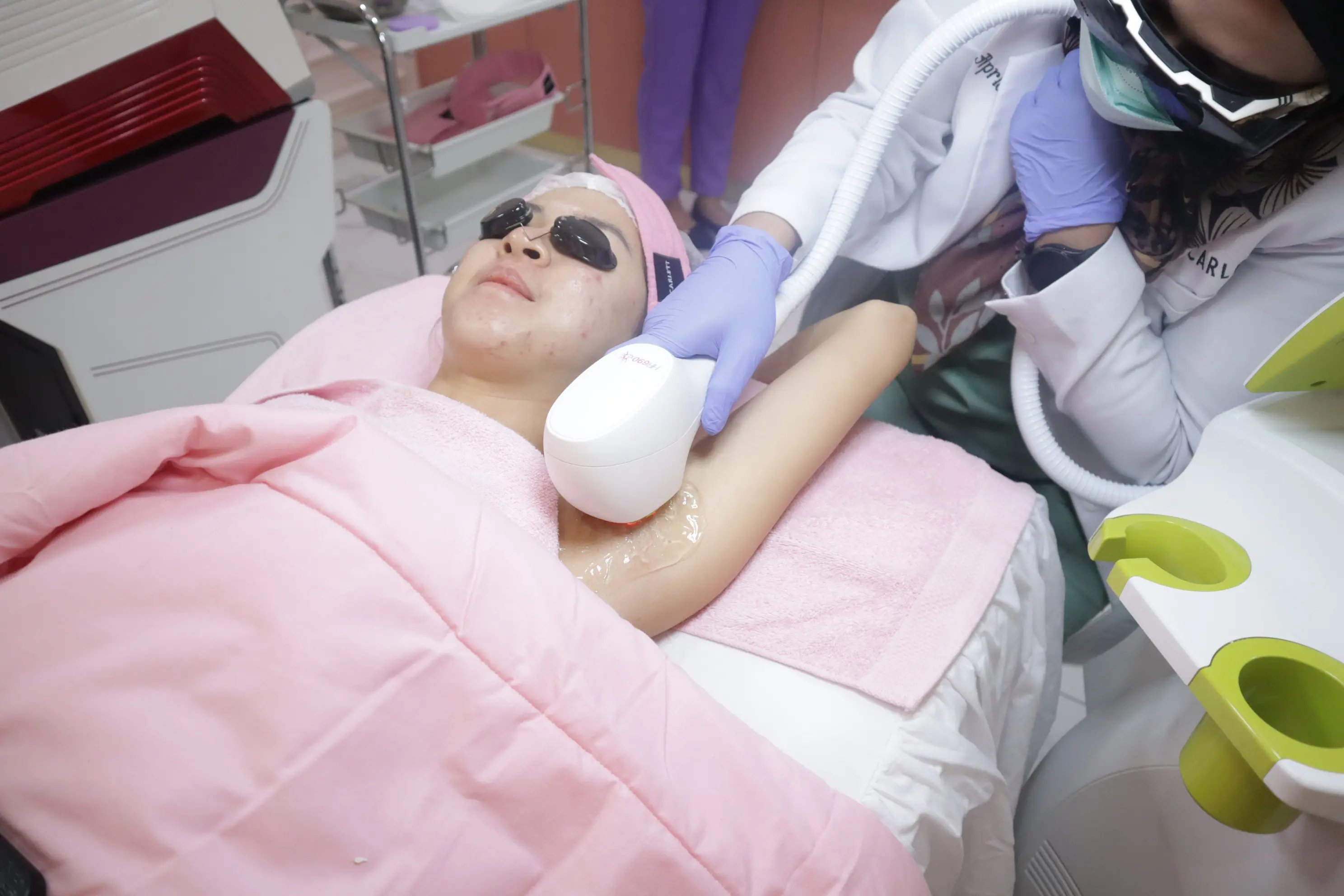 Underarm Hair Removal Versa treatment